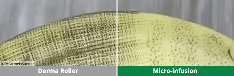 Comparaison angle pénétration : derma-roller en biais vs micro-infusion verticale